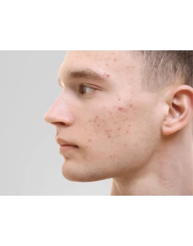 Acne vulgaris