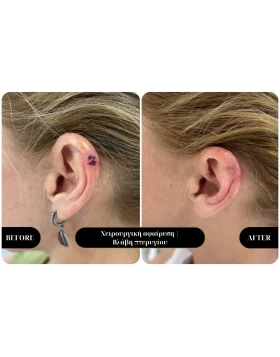 Dermatological surgery