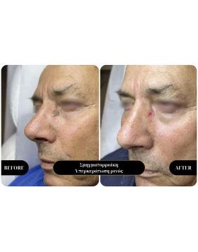 Seborrheic keratosis