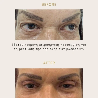 Άνω Βλεφαροπλαστική