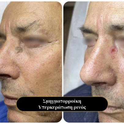 Σμηγματορροϊκή Υπερκεράτωση